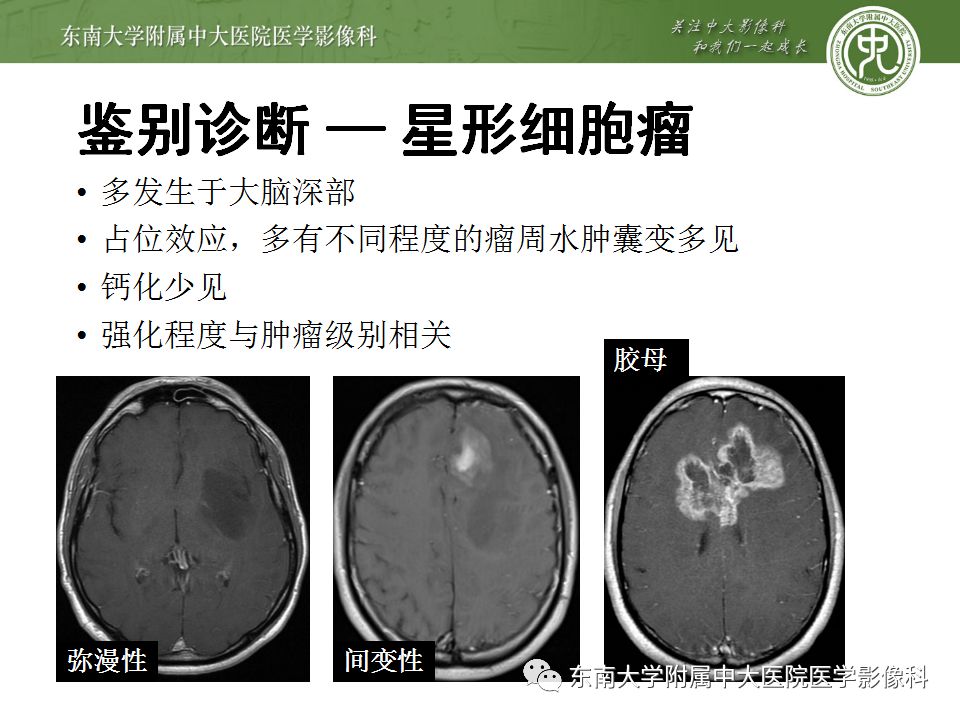 【病例】少突胶质细胞瘤1例MR影像诊断分析