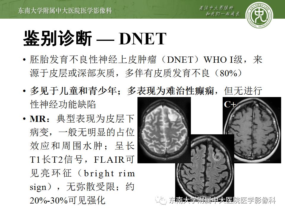 【病例】少突胶质细胞瘤1例MR影像诊断分析