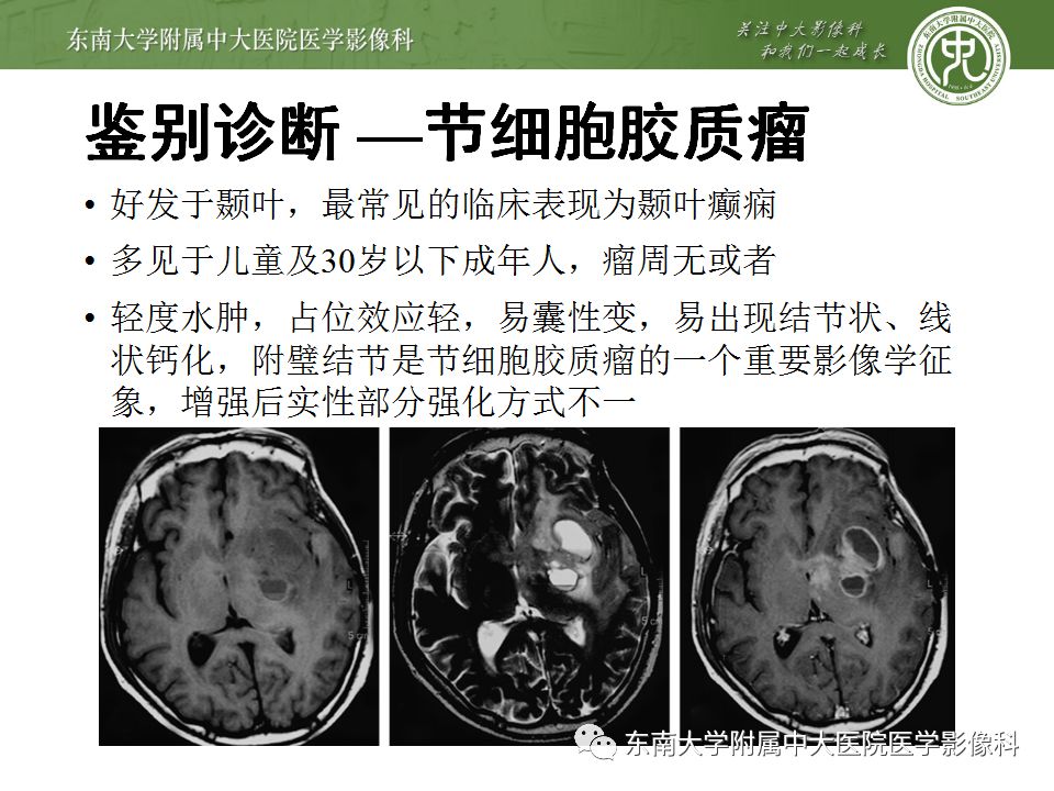 【病例】少突胶质细胞瘤1例MR影像诊断分析