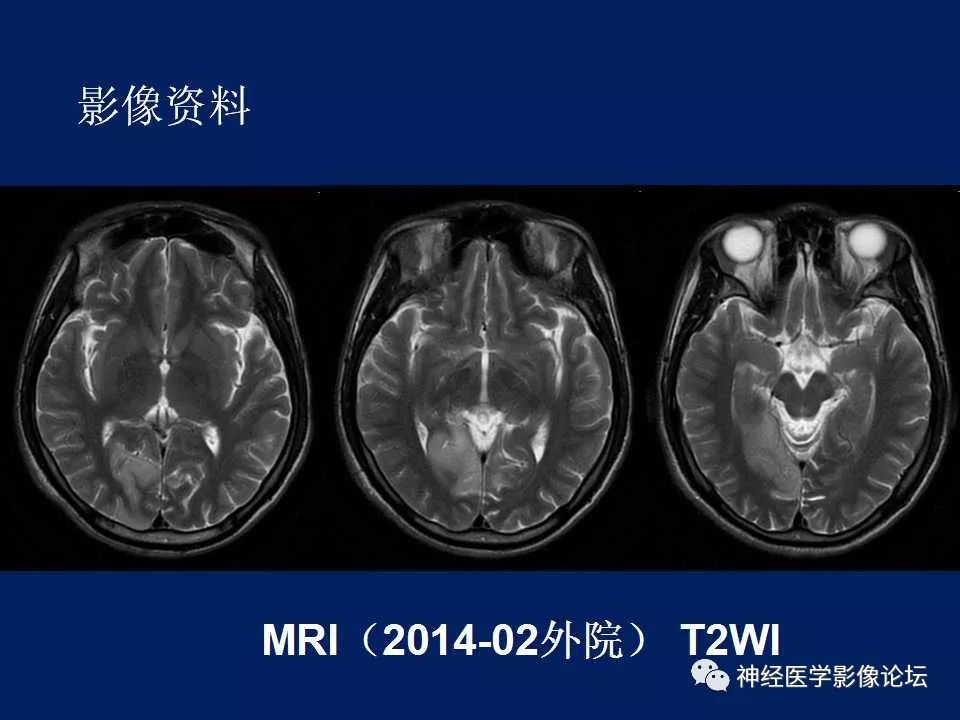 【病例】MELAS型线粒体脑病1例MR影像表现