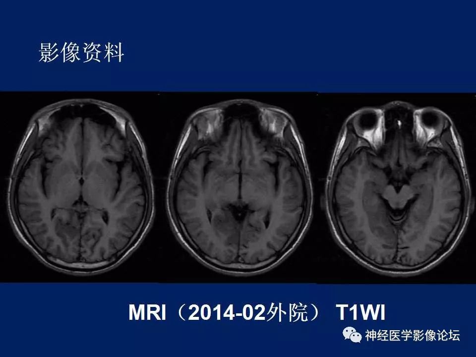 【病例】MELAS型线粒体脑病1例MR影像表现