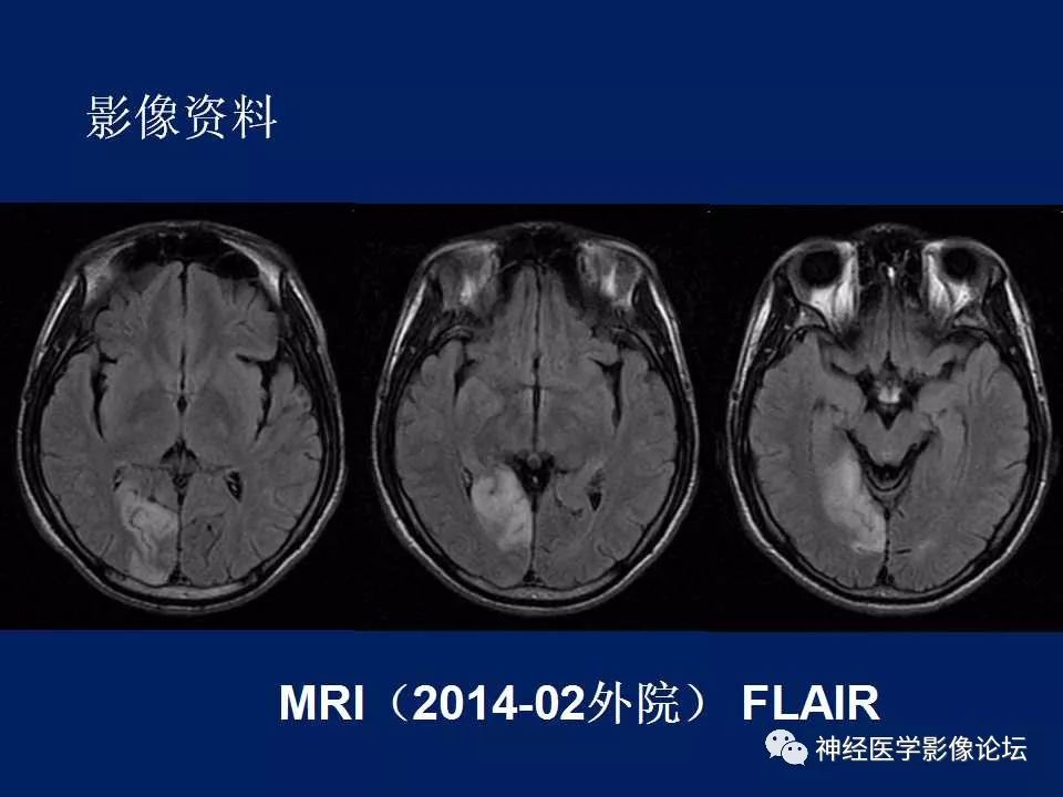 【病例】MELAS型线粒体脑病1例MR影像表现