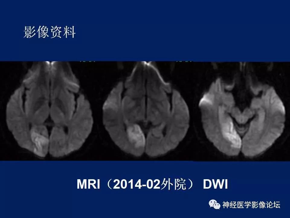 【病例】MELAS型线粒体脑病1例MR影像表现