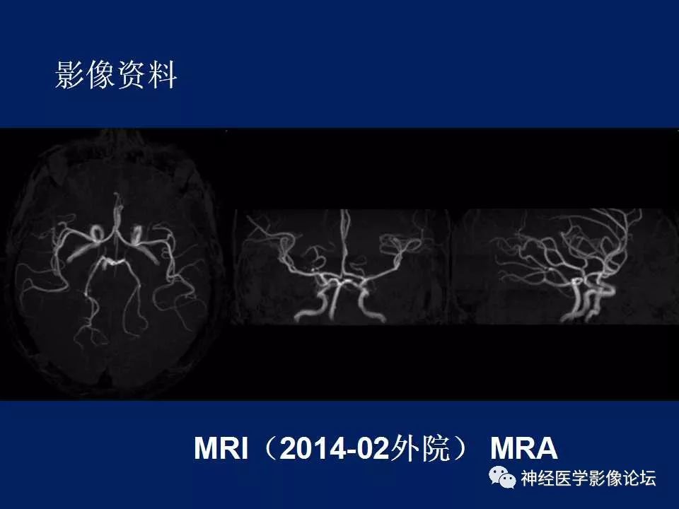 【病例】MELAS型线粒体脑病1例MR影像表现