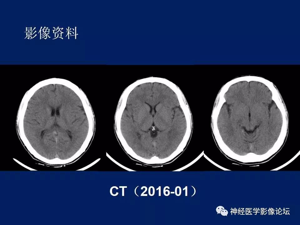 【病例】MELAS型线粒体脑病1例MR影像表现
