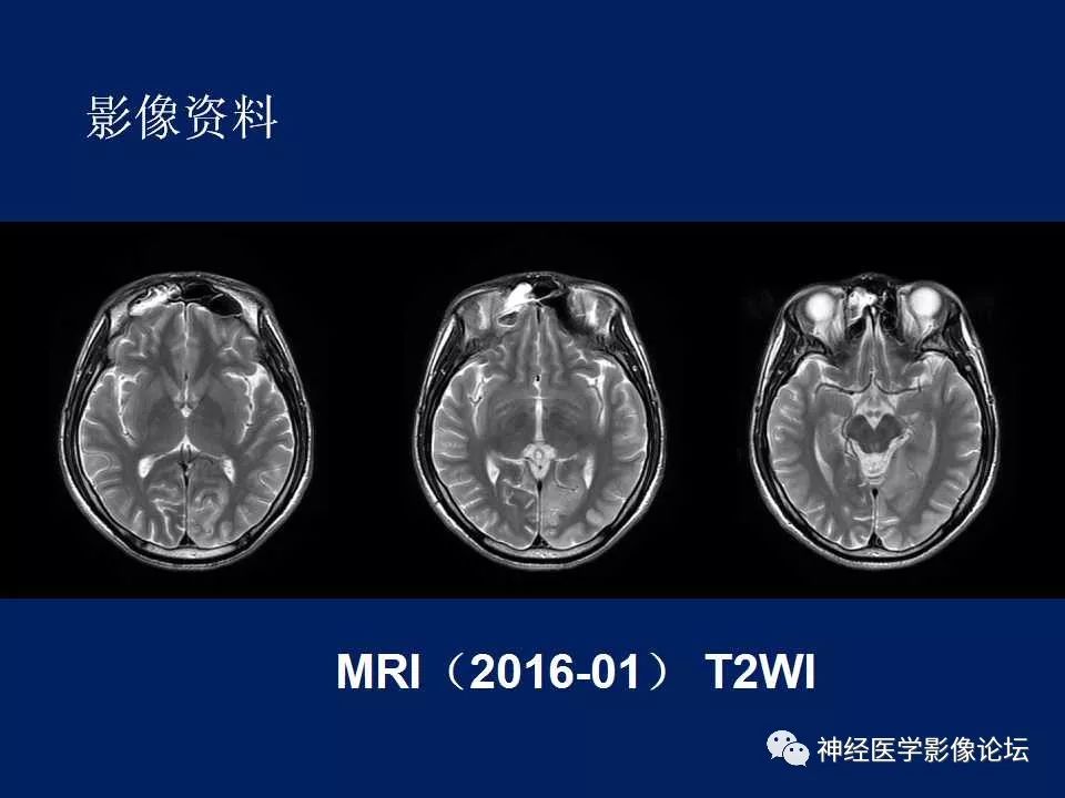 【病例】MELAS型线粒体脑病1例MR影像表现