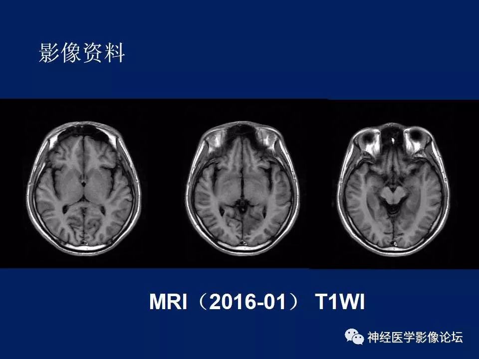 【病例】MELAS型线粒体脑病1例MR影像表现
