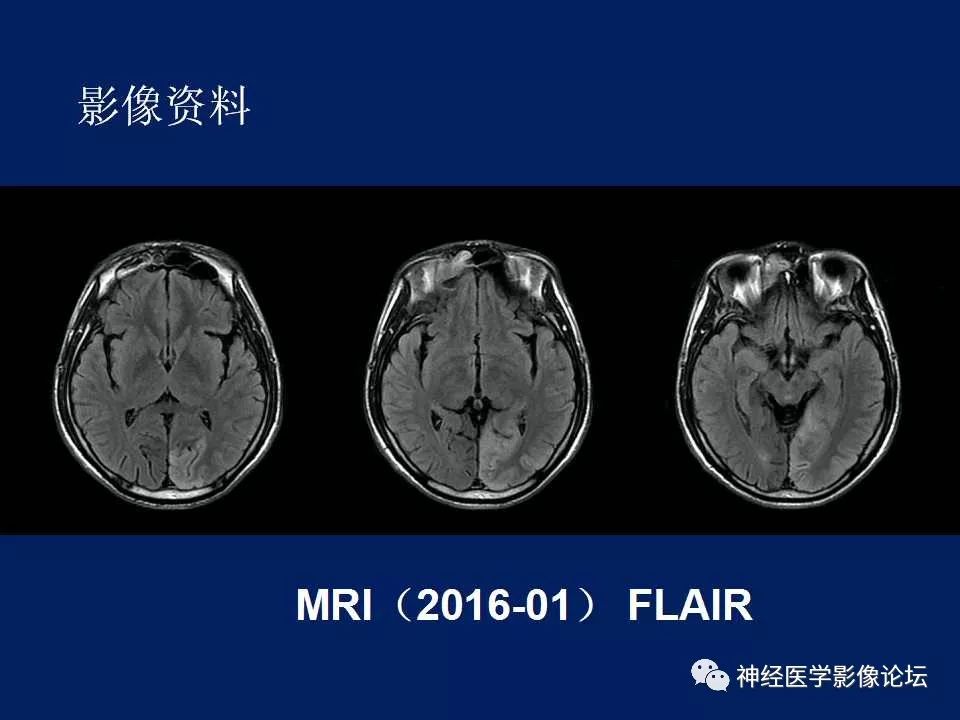 【病例】MELAS型线粒体脑病1例MR影像表现