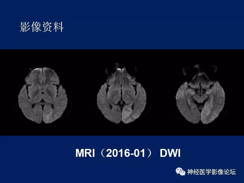 【病例】MELAS型线粒体脑病1例MR影像表现