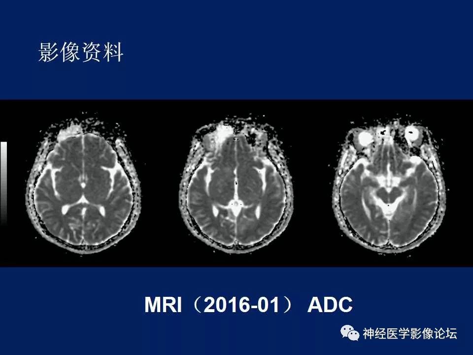 【病例】MELAS型线粒体脑病1例MR影像表现