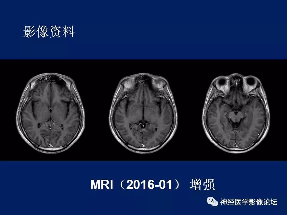 【病例】MELAS型线粒体脑病1例MR影像表现