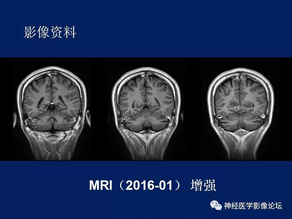【病例】MELAS型线粒体脑病1例MR影像表现