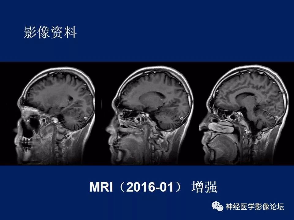 【病例】MELAS型线粒体脑病1例MR影像表现
