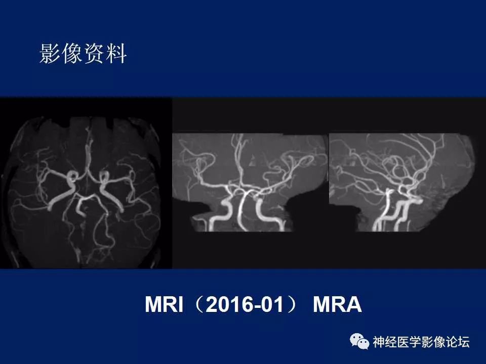 【病例】MELAS型线粒体脑病1例MR影像表现