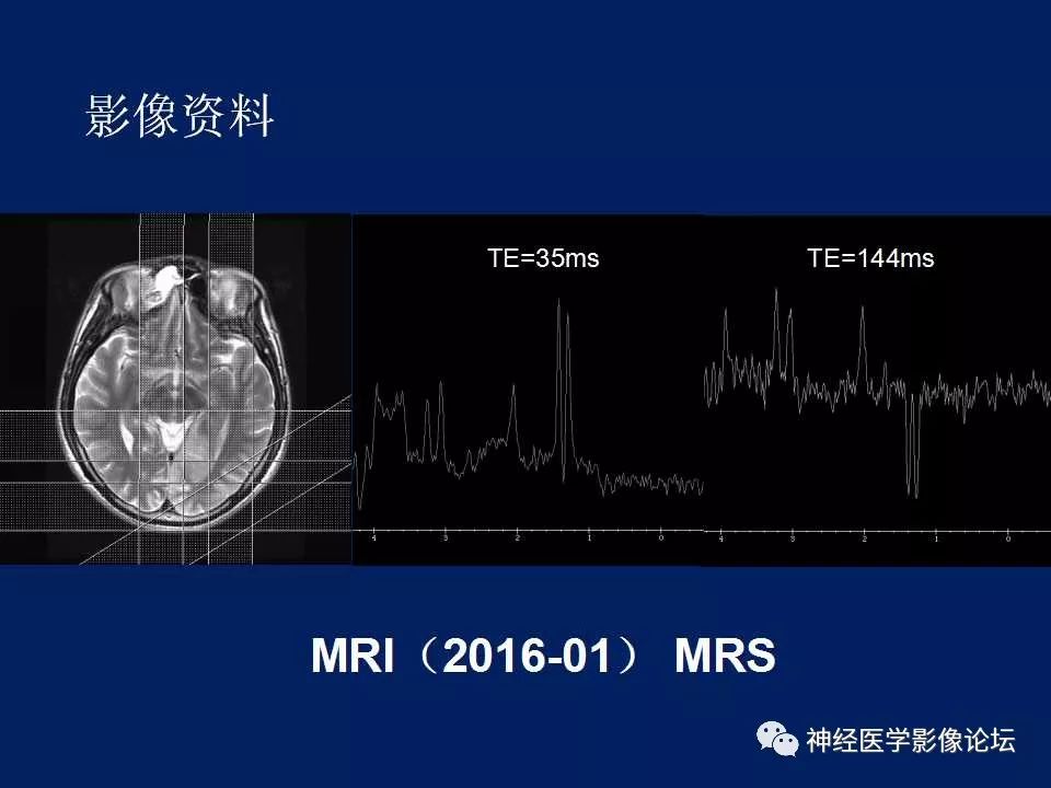 【病例】MELAS型线粒体脑病1例MR影像表现