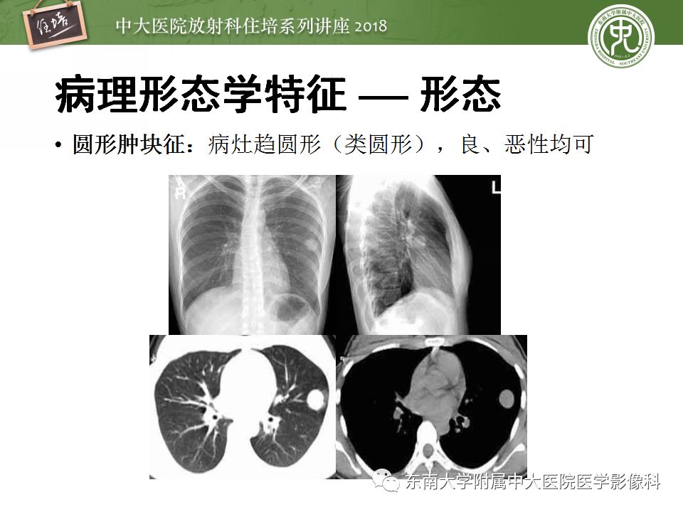 【PPT】 肺部结节与肿块的影像诊断与鉴别诊断