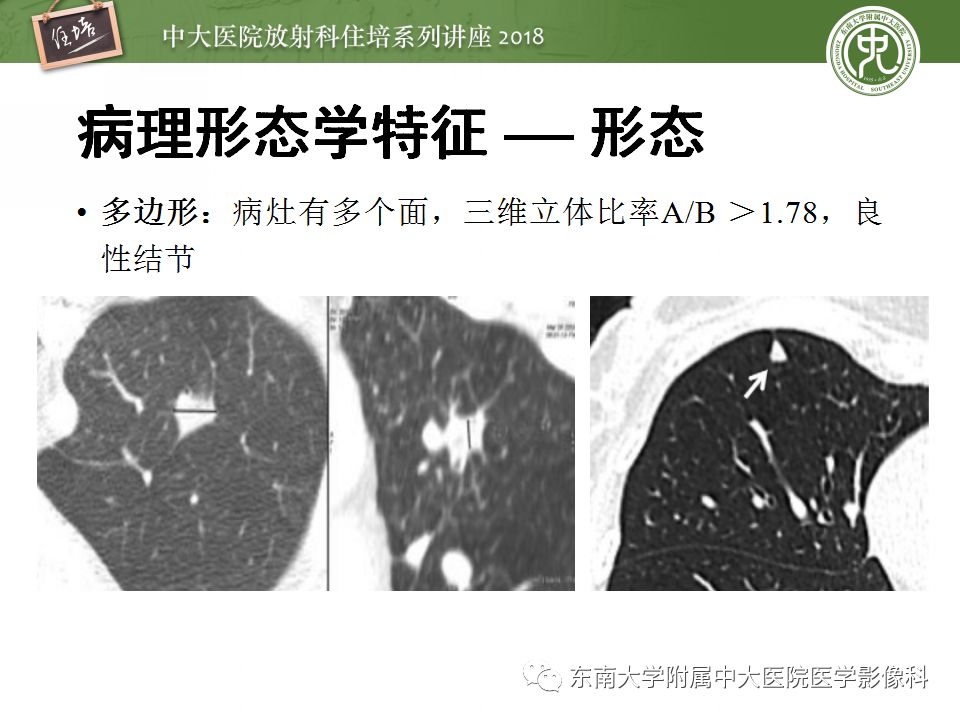 【PPT】 肺部结节与肿块的影像诊断与鉴别诊断
