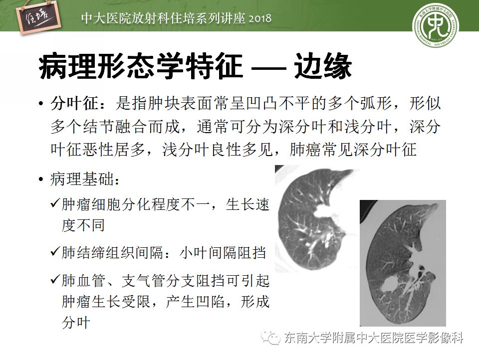 【PPT】 肺部结节与肿块的影像诊断与鉴别诊断