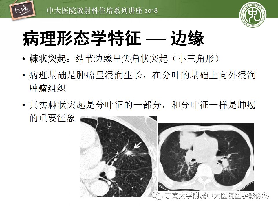 【PPT】 肺部结节与肿块的影像诊断与鉴别诊断
