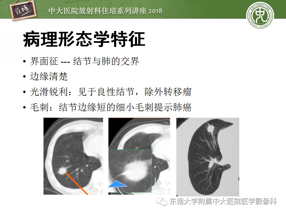 【PPT】 肺部结节与肿块的影像诊断与鉴别诊断