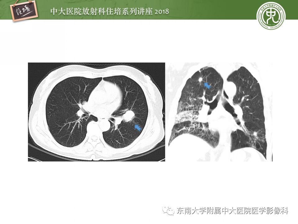 【PPT】 肺部结节与肿块的影像诊断与鉴别诊断