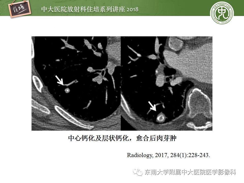 【PPT】 肺部结节与肿块的影像诊断与鉴别诊断