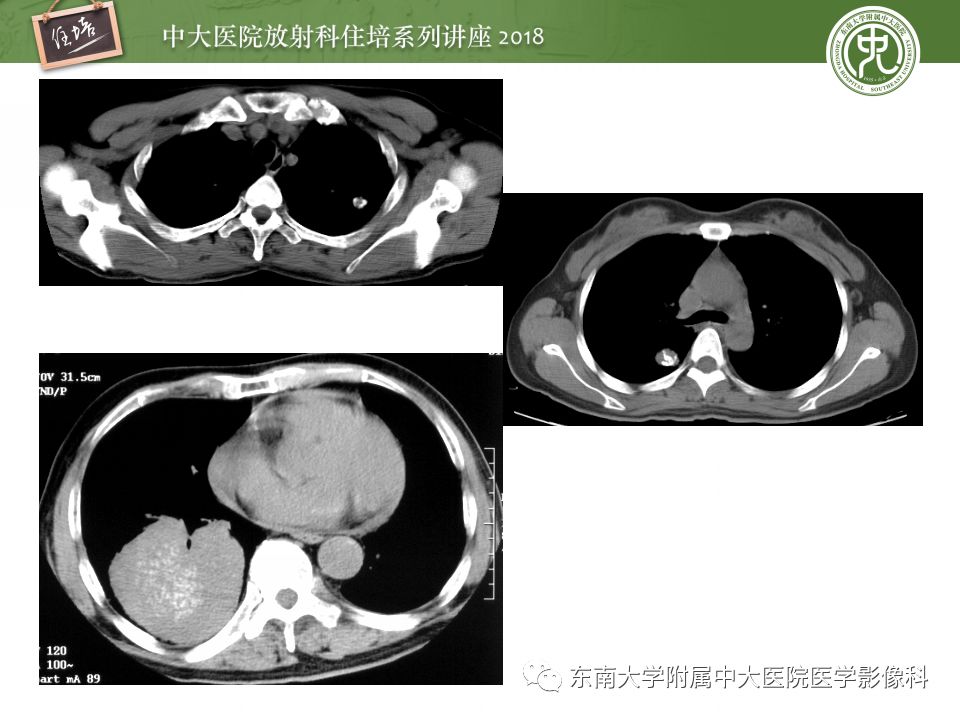 【PPT】 肺部结节与肿块的影像诊断与鉴别诊断