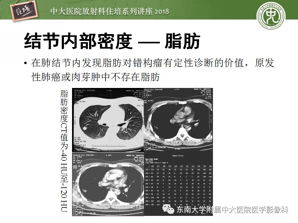 【PPT】 肺部结节与肿块的影像诊断与鉴别诊断