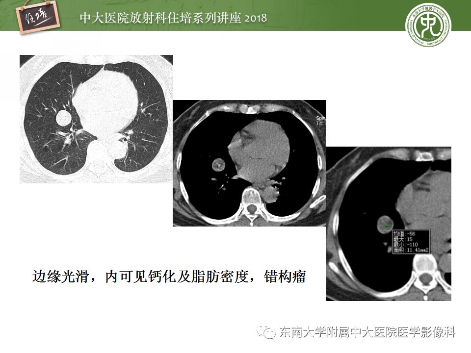 【PPT】 肺部结节与肿块的影像诊断与鉴别诊断