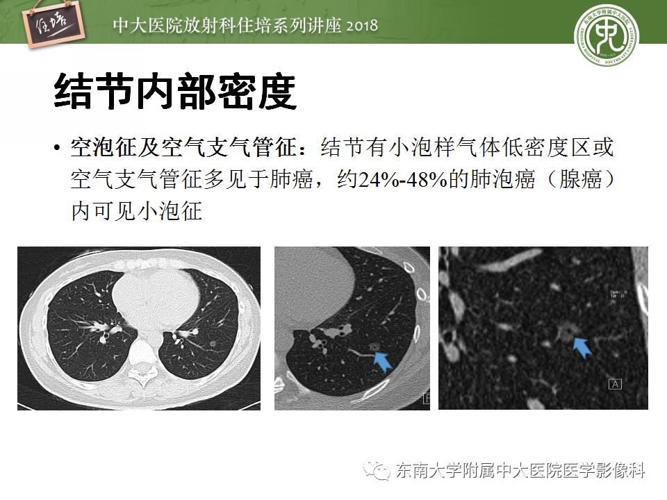 【PPT】 肺部结节与肿块的影像诊断与鉴别诊断