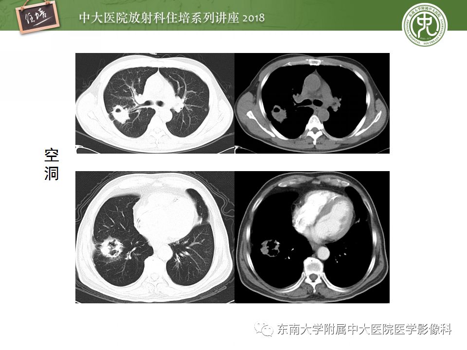 【PPT】 肺部结节与肿块的影像诊断与鉴别诊断