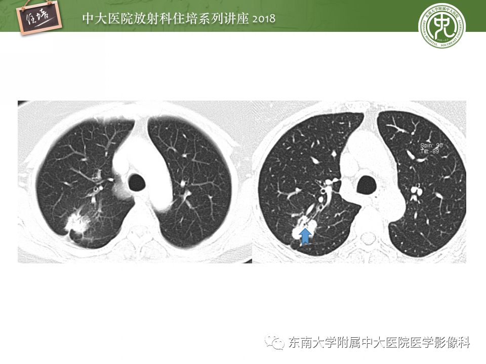 【PPT】 肺部结节与肿块的影像诊断与鉴别诊断
