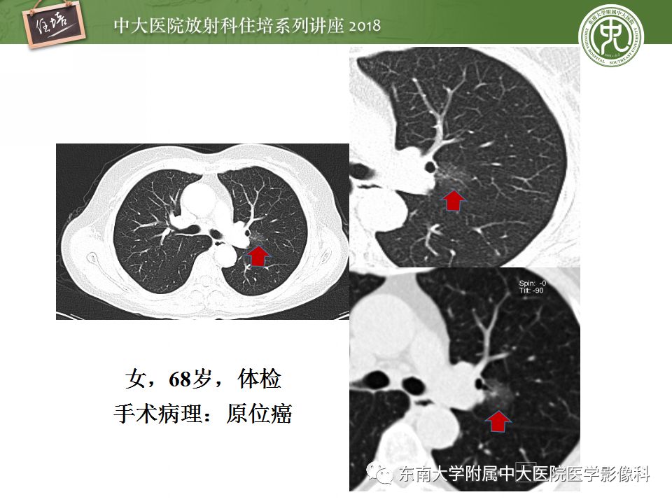 【PPT】 肺部结节与肿块的影像诊断与鉴别诊断