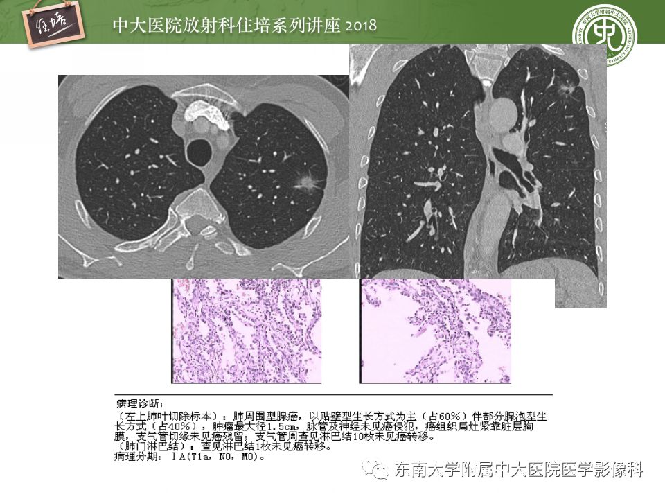【PPT】 肺部结节与肿块的影像诊断与鉴别诊断