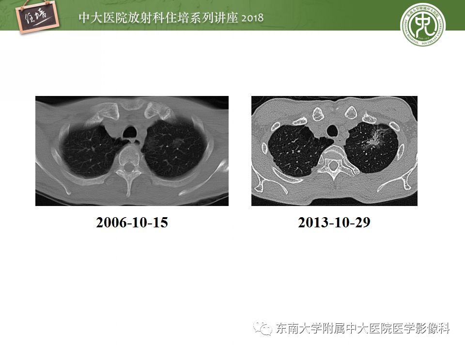 【PPT】 肺部结节与肿块的影像诊断与鉴别诊断