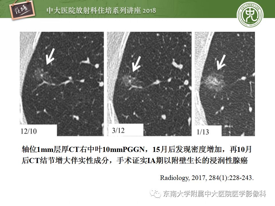 【PPT】 肺部结节与肿块的影像诊断与鉴别诊断
