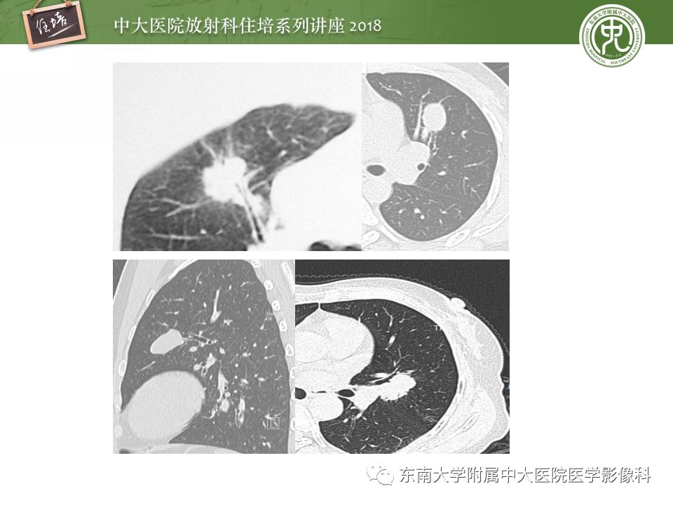 【PPT】 肺部结节与肿块的影像诊断与鉴别诊断