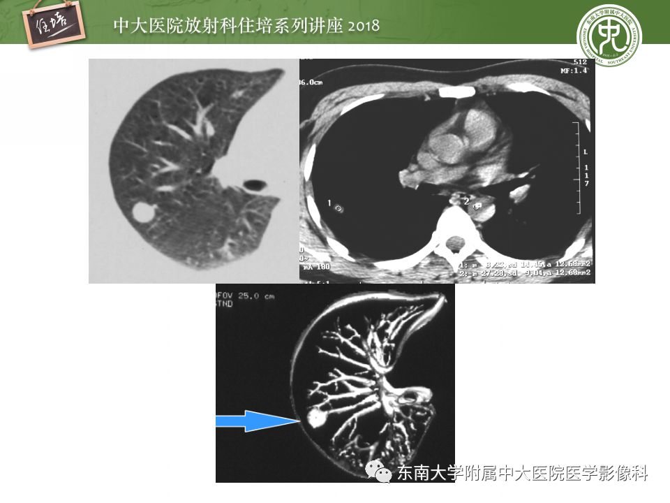 【PPT】 肺部结节与肿块的影像诊断与鉴别诊断