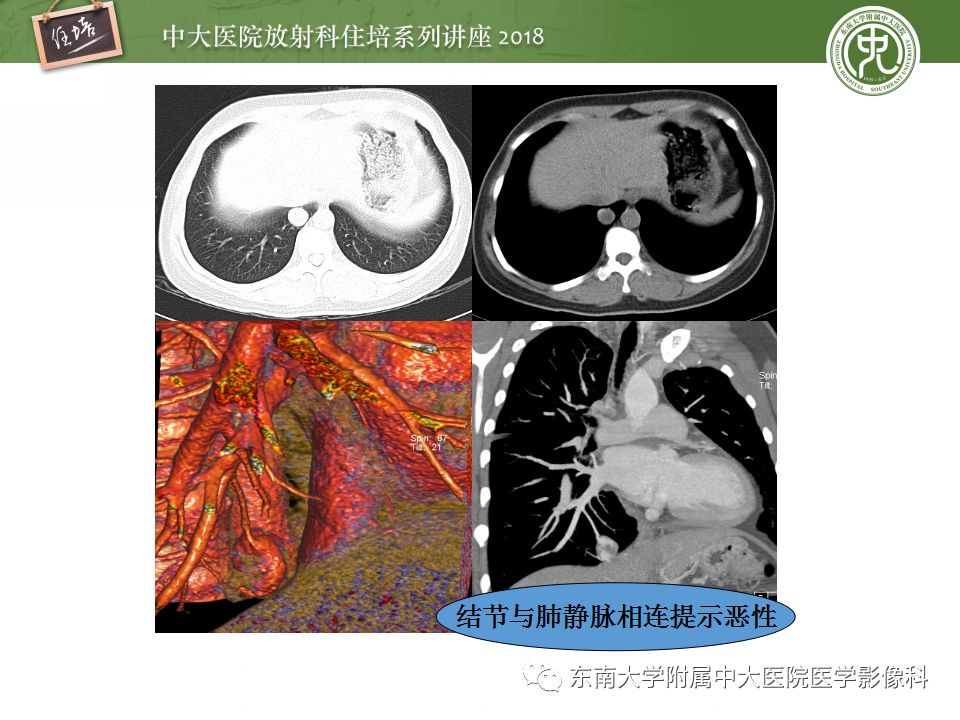 【PPT】 肺部结节与肿块的影像诊断与鉴别诊断