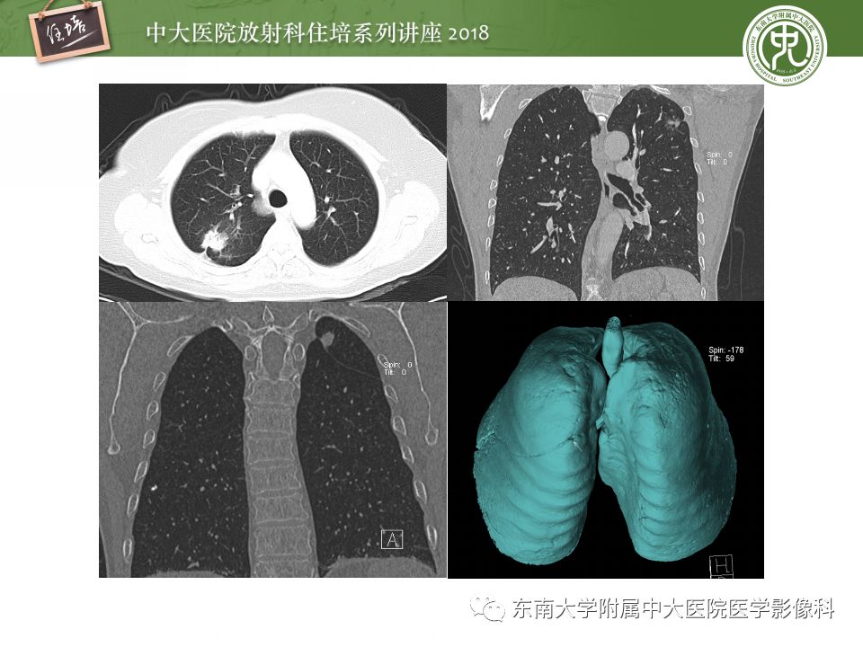 【PPT】 肺部结节与肿块的影像诊断与鉴别诊断