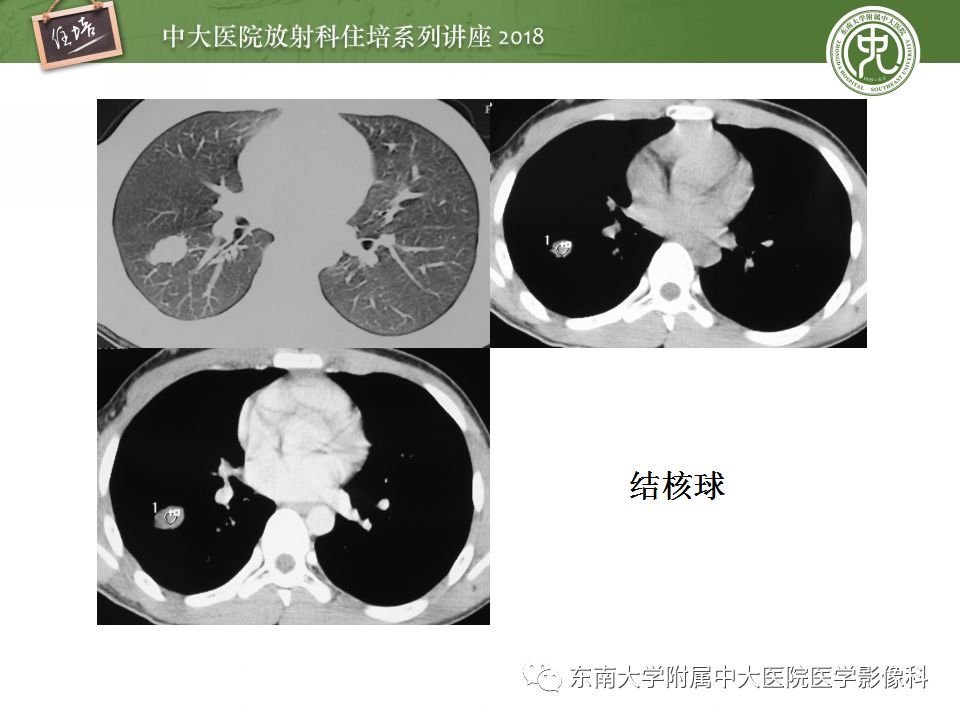 【PPT】 肺部结节与肿块的影像诊断与鉴别诊断