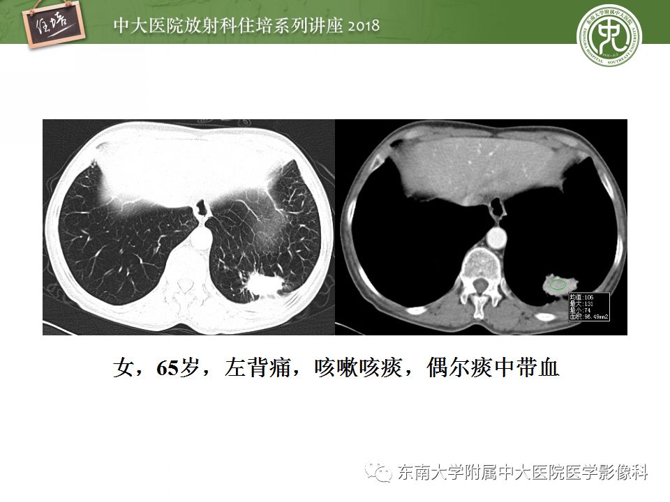 【PPT】 肺部结节与肿块的影像诊断与鉴别诊断