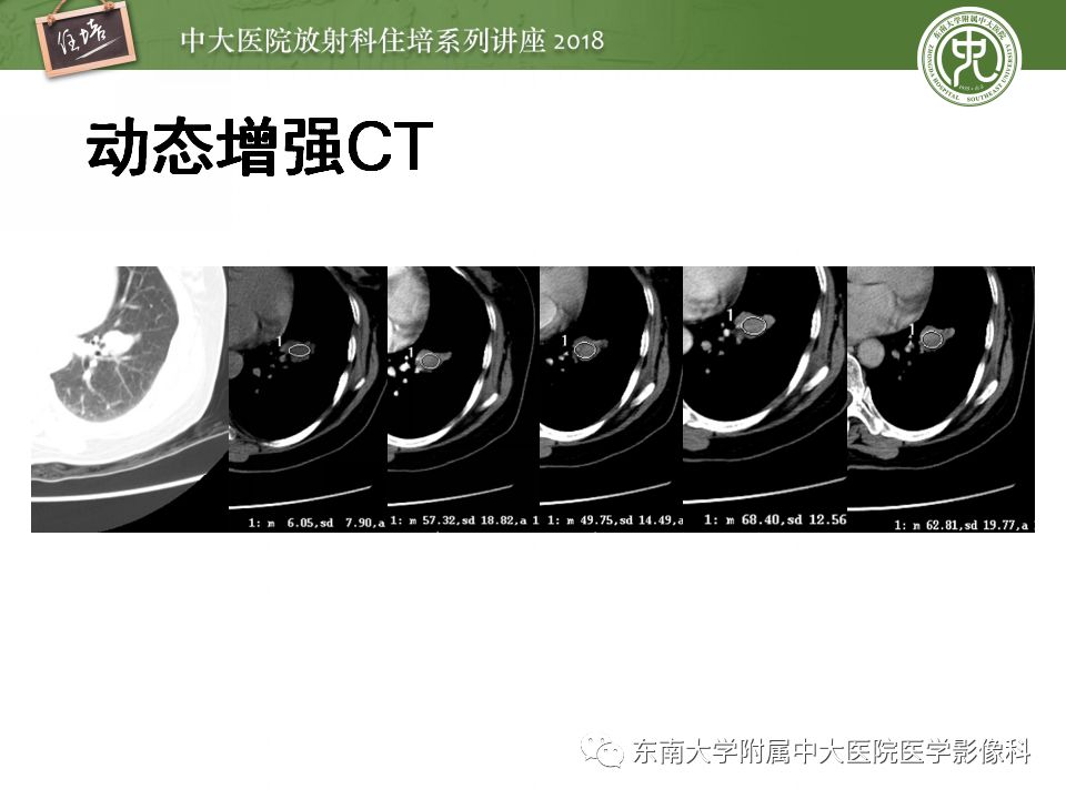 【PPT】 肺部结节与肿块的影像诊断与鉴别诊断