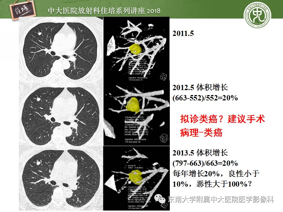 【PPT】 肺部结节与肿块的影像诊断与鉴别诊断
