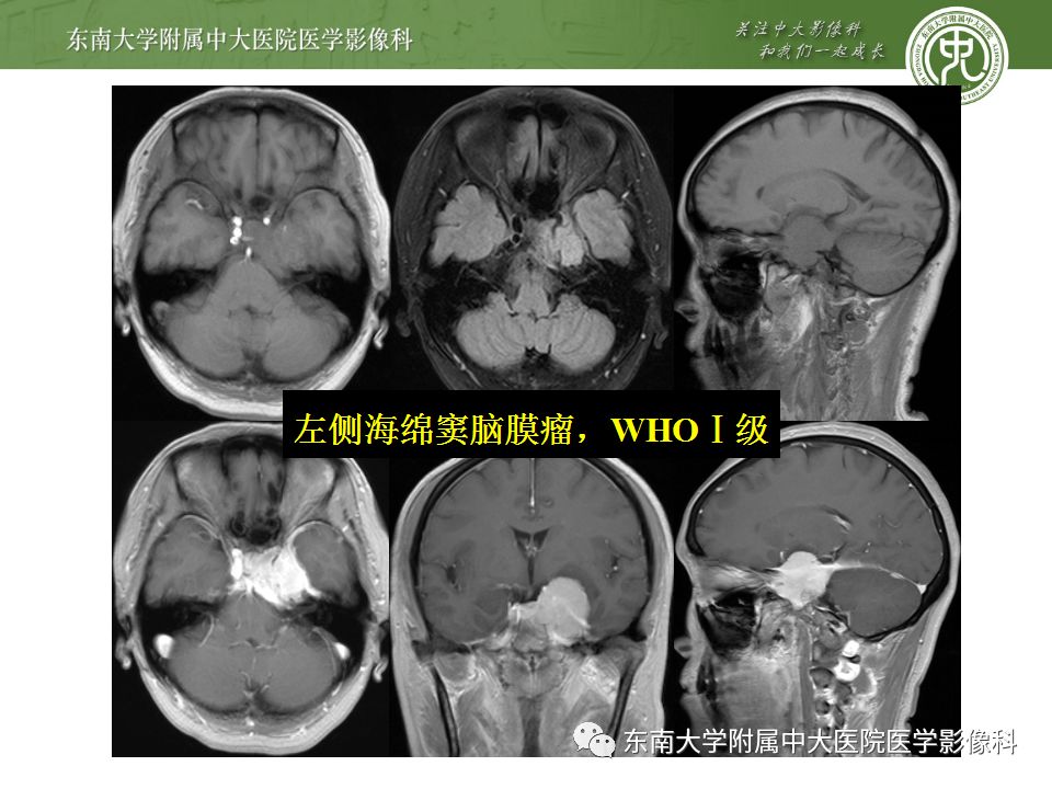 【病例】右侧动眼神经鞘瘤1例MR