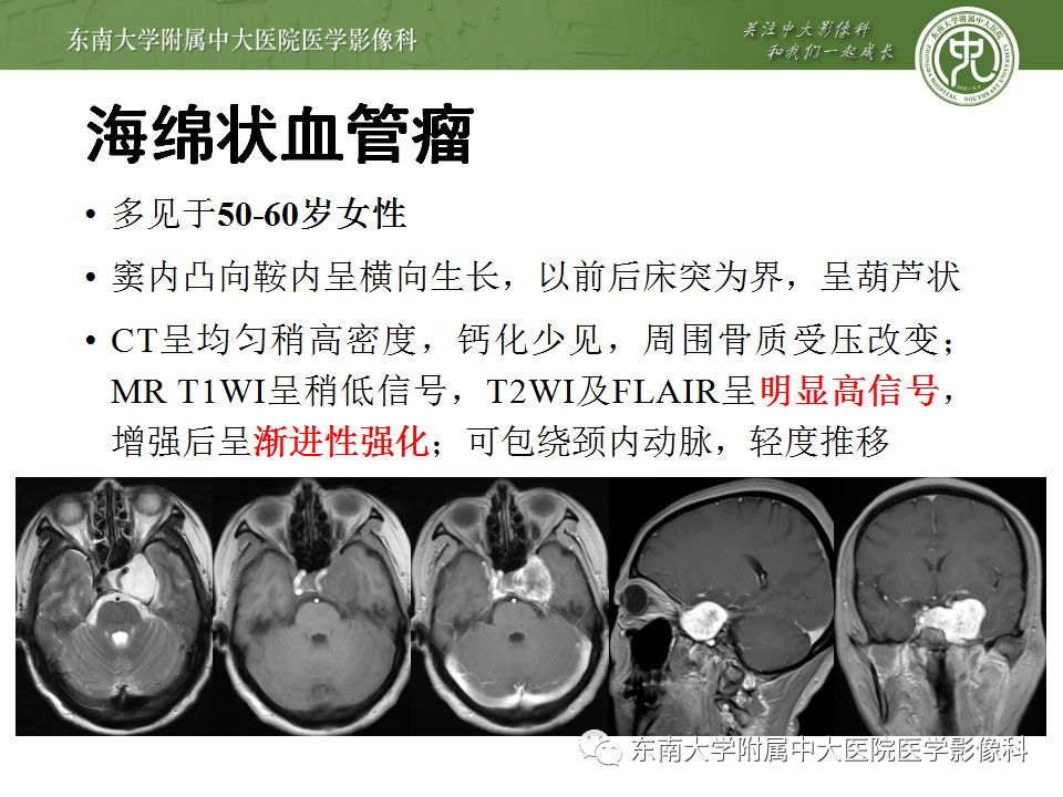 【病例】右侧动眼神经鞘瘤1例MR