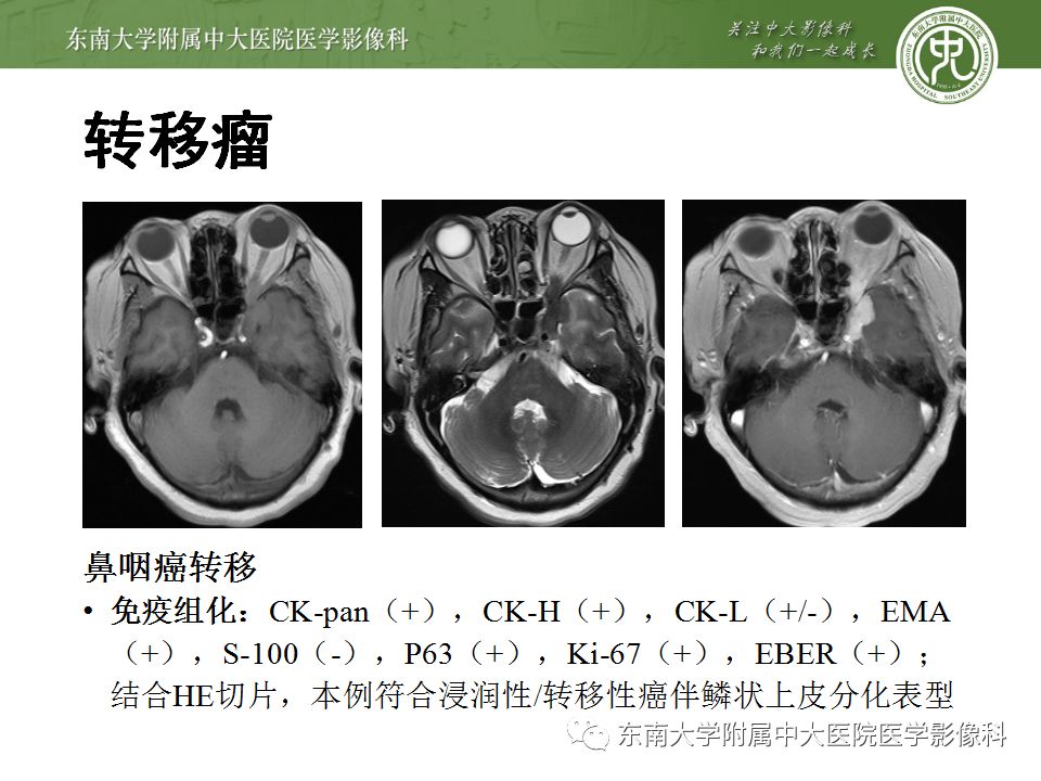 【病例】右侧动眼神经鞘瘤1例MR