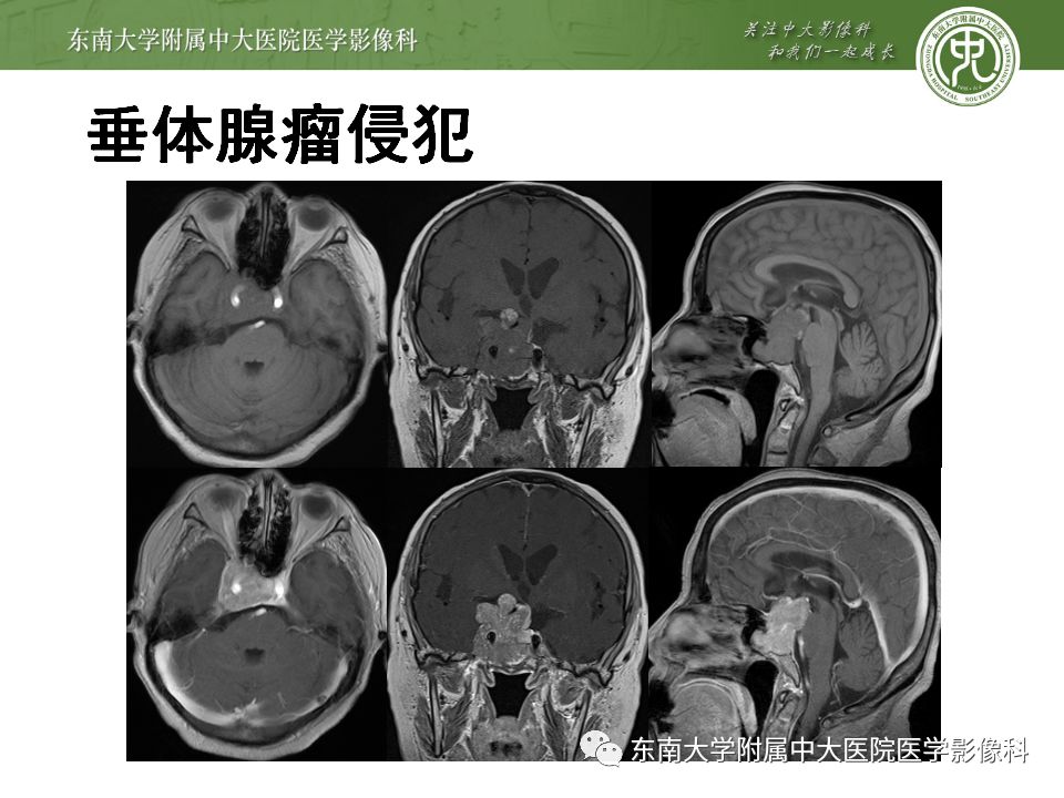 【病例】右侧动眼神经鞘瘤1例MR