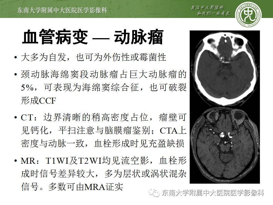 【病例】右侧动眼神经鞘瘤1例MR