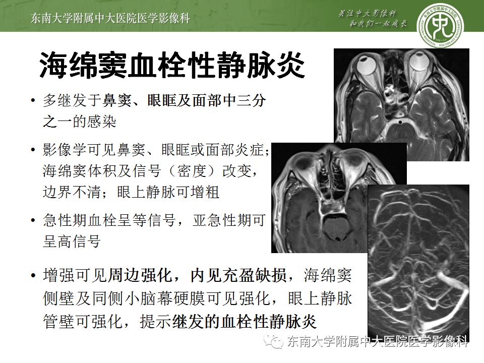 【病例】右侧动眼神经鞘瘤1例MR